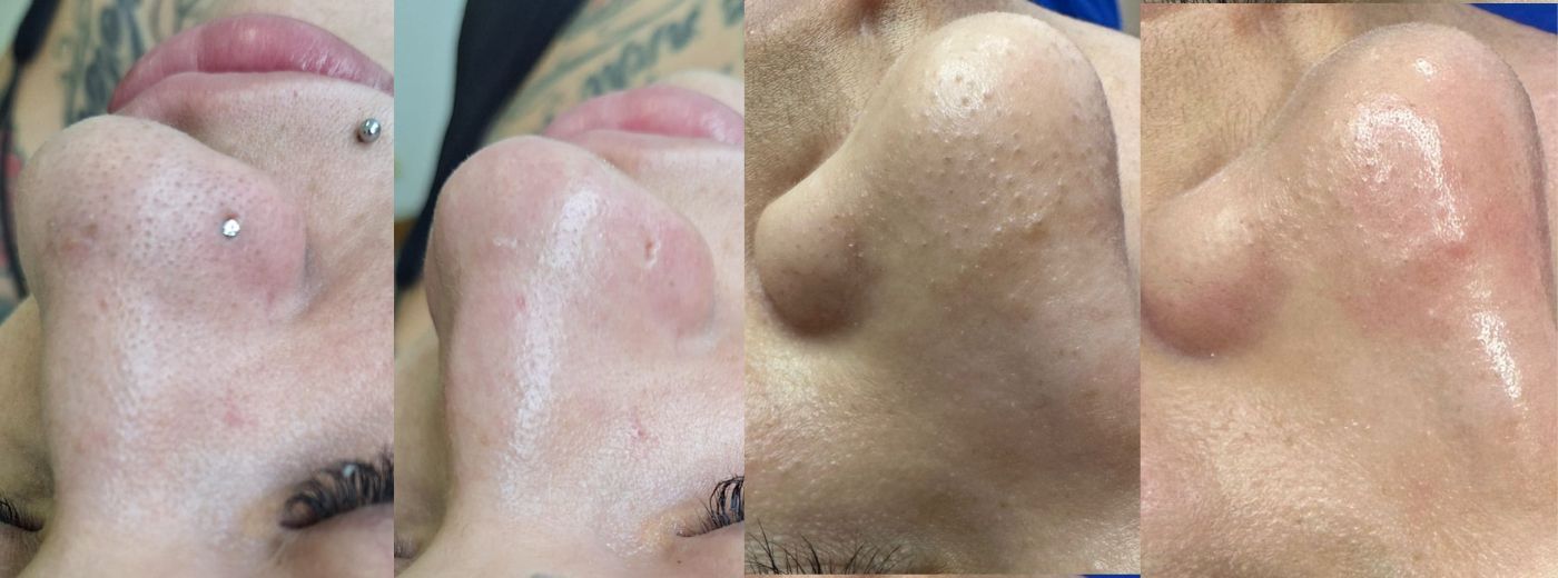 Limpeza de Pele com Extração + Massagem Facial + GANHE Protocolo de Detox Facial!