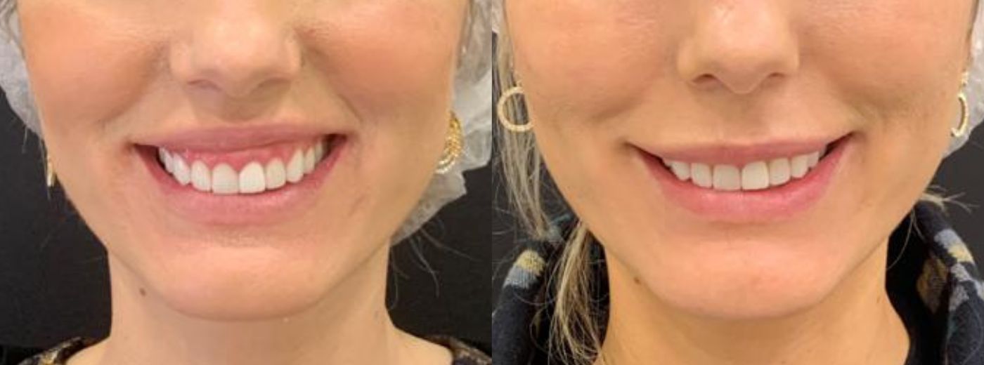 Aplicação de Toxina Botulínica Dysport® ou Botulift® para Sorriso Gengival