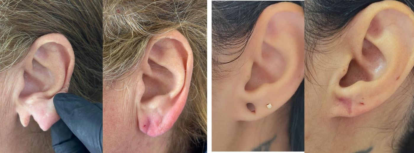 Restaure suas orelhas sem cirurgia: Lobuloplastia sem cortes
