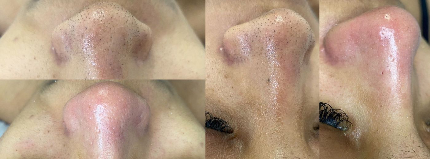 Mini Spa Facial: Limpeza de Pele com Extração + Peeling de Diamante + Vapor de Ozônio + Fototerapia e Drenagem Facial!