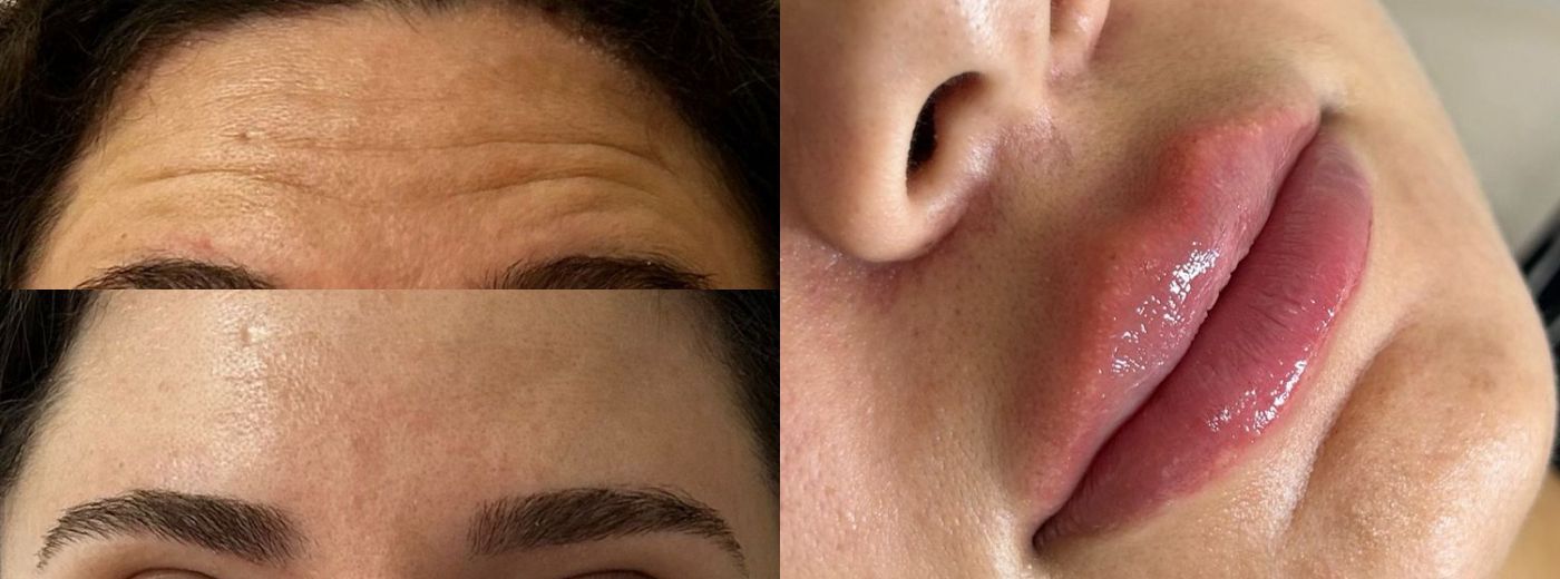 Aplicação de Toxina Botulínica para 3 Regiões (Testa, Glabela e Olhos) + Preenchimento com 1ml de Ácido Hialurônico