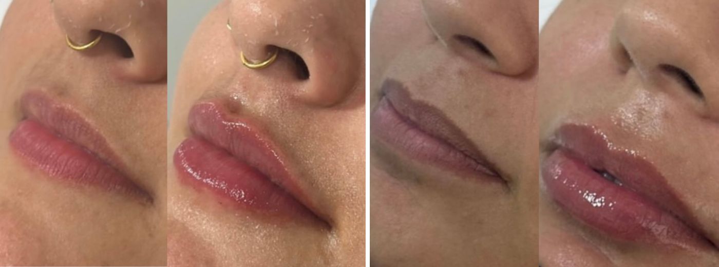Preenchimento com 1ml de Ácido Hialurônico para Lábios, Olheiras OU Sulco Nasogeniano