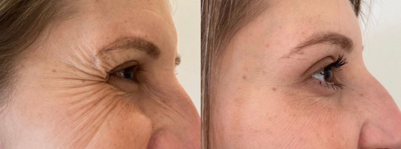 Botox Allergan® ou Xeomin® para 2 Regiões: Testa, Olhos ou Glabela