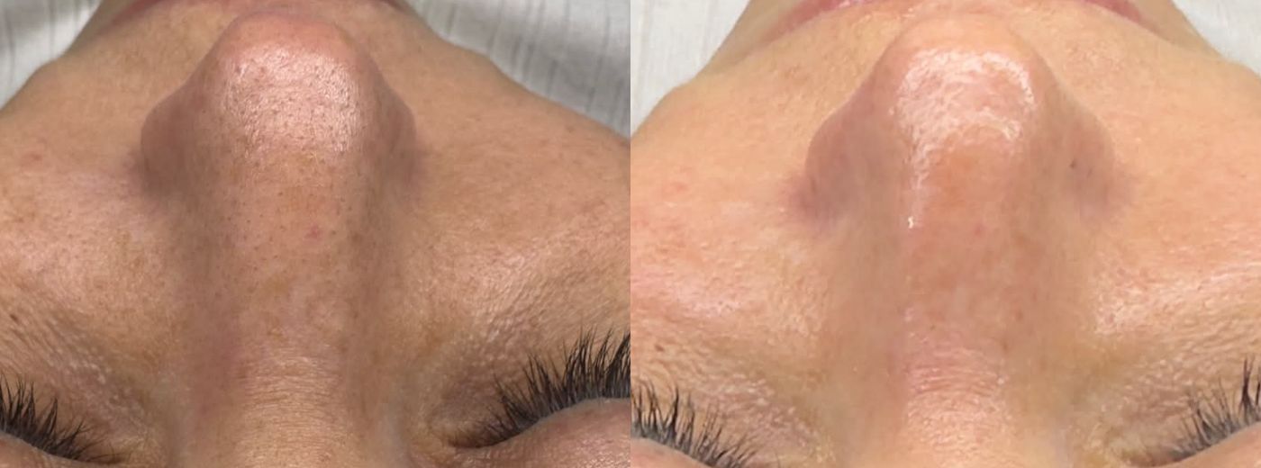 Renove sua Pele: Limpeza de Pele + Sucção + Vapor de Ozônio + Led Terapia + Alta Frequência e Máscara Facial