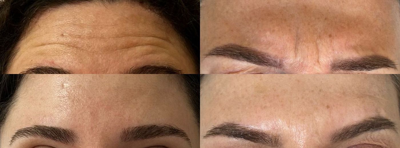 Adeus, rugas! Botox Allergan® ou Nabota® para 4 regiões
