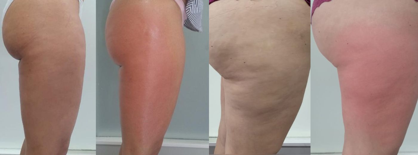 Adeus, Celulite! 5 Sessões de VelaShape II para 2 regiões!