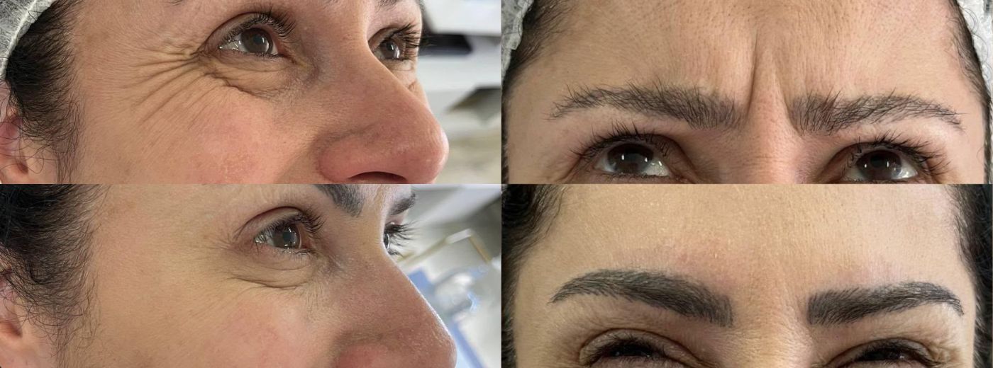 Aplicação de Toxina Botulínica Xeomin® para Testa, Glabela e Orbicular dos Olhos