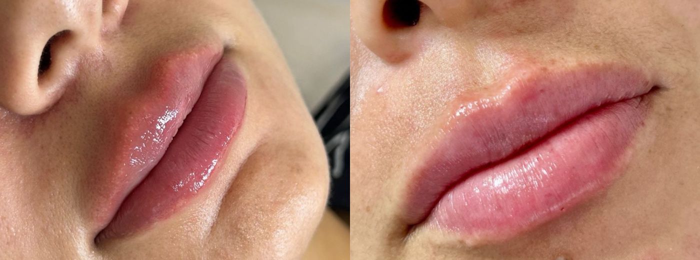 Mais volume com naturalidade! Preenchimento Labial com 1ml de Ácido Hialurônico