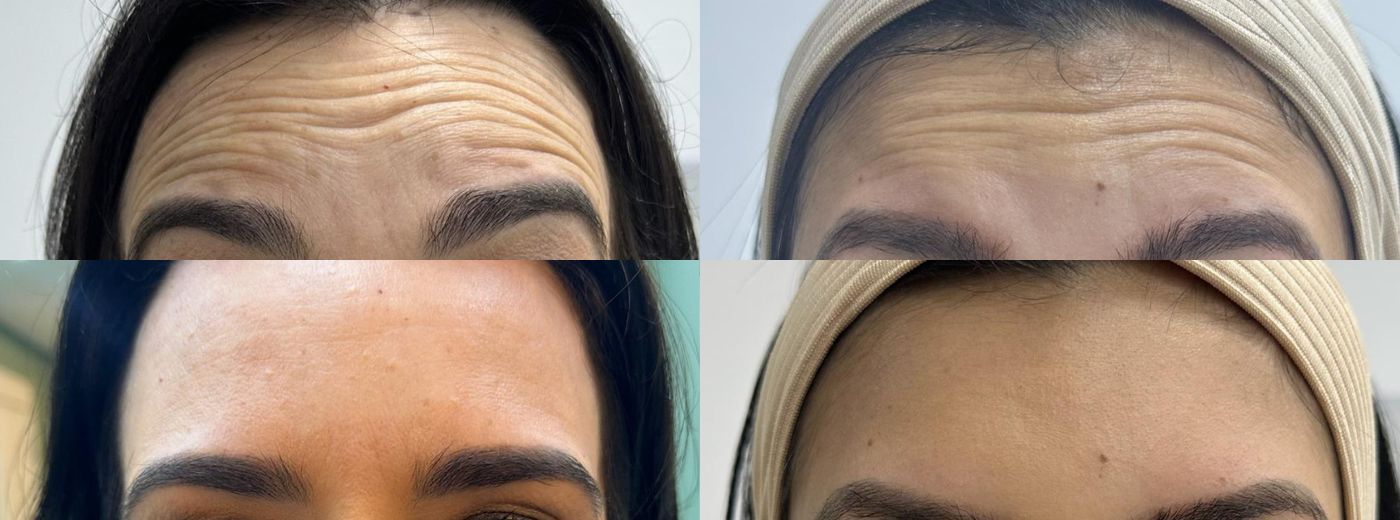 Toxina Botulínica Coreana Letybo® para Testa + Olhos + Glabela - última geração com efeito mais rápido e preciso!