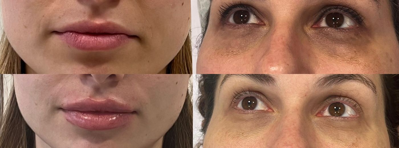 Preenchimento com 2ml de Ácido Hialurônico Rennova Lift®