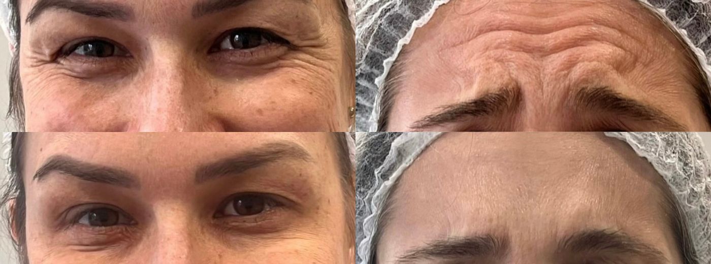 Aplicação de Toxina Botulínica Dysport® para 2 Regiões (Testa + Olhos OU Glabela)