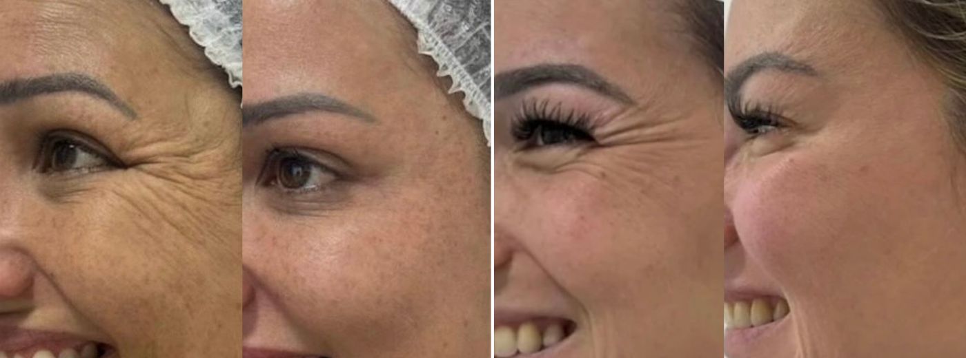 Aplicação de Toxina Botulínica para 3 Regiões + GANHE Peeling Químico ou Hidratação Facial!
