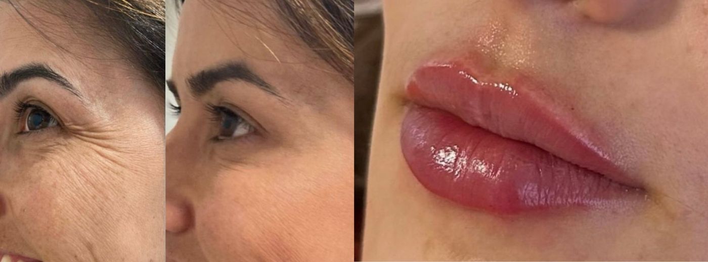Aplicação de Toxina Botulínica Xeomin® (3 Regiões) + 2ml Preenchimento! | BLACK