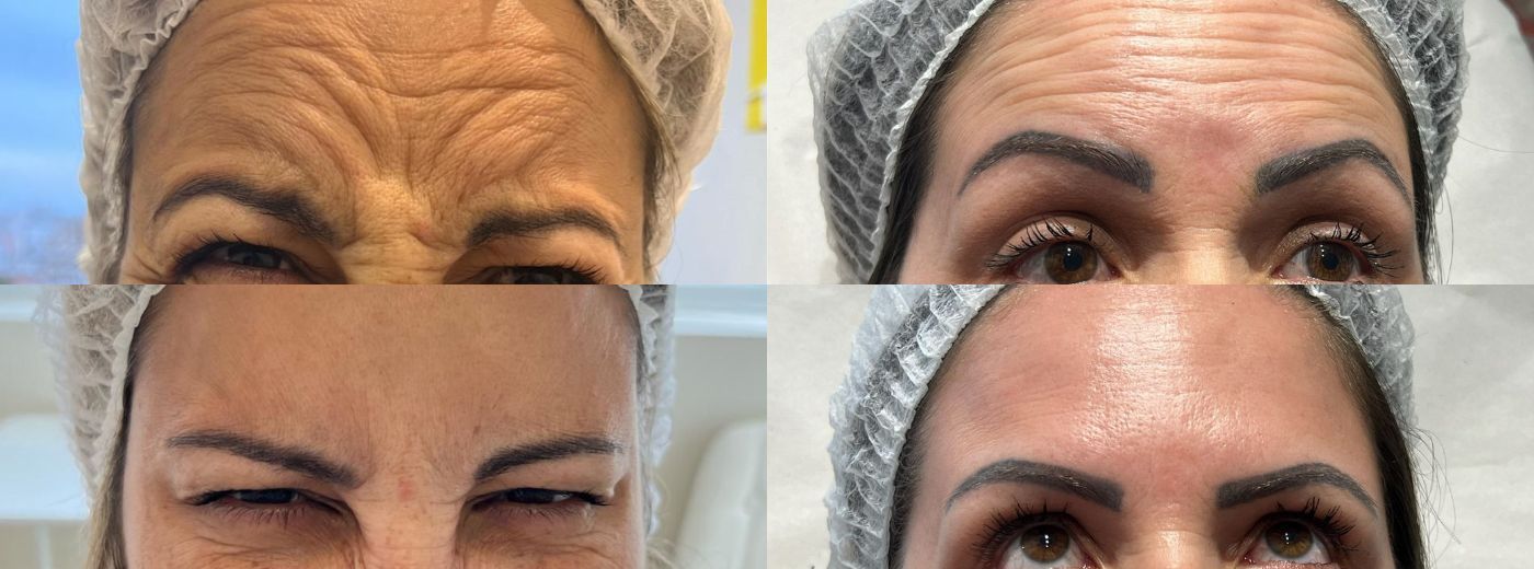 Aplicação de Toxina Botulínica para Testa, Glabela e Orbicular dos Olhos + GANHE Peeling de Diamante!