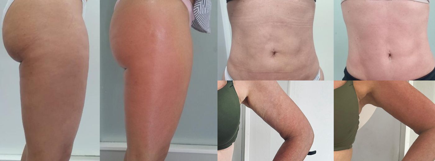 Adeus, Celulite! 8 Sessões de VelaShape II + GANHE 1 Sessão de Trynea para Flacidez nos Braços!