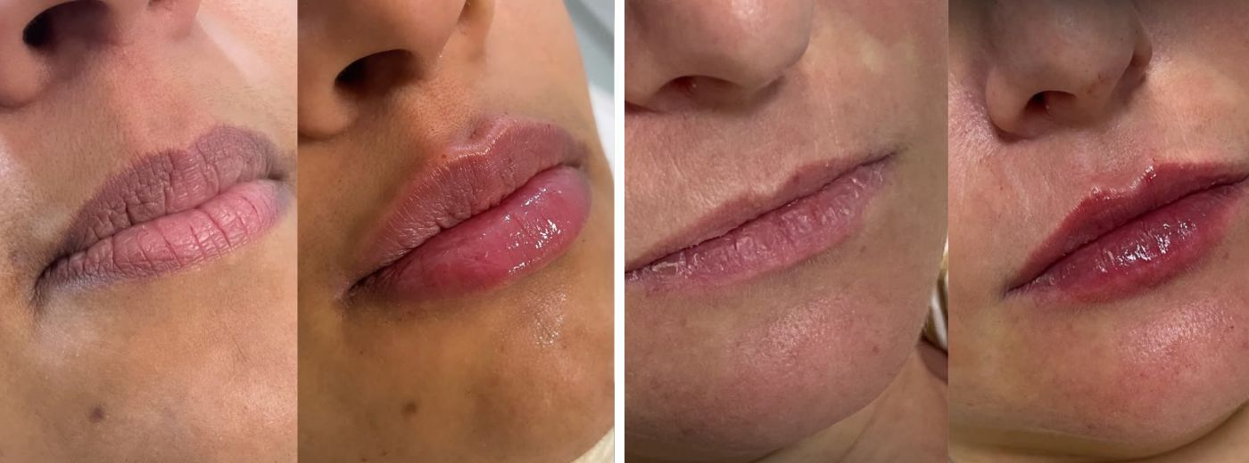 Mais volume com naturalidade! Preenchimento Labial com 1ml de Ácido Hialurônico