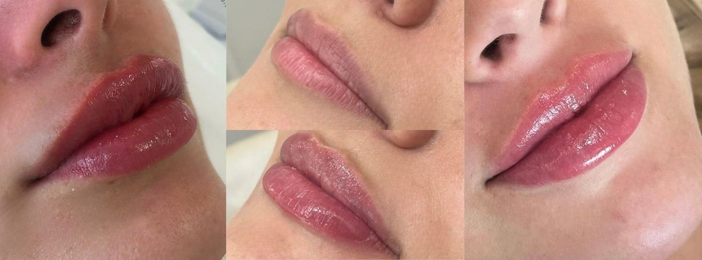 Preenchimento Labial com 1ml de Ácido Hialurônico - Por tempo LIMITADO!