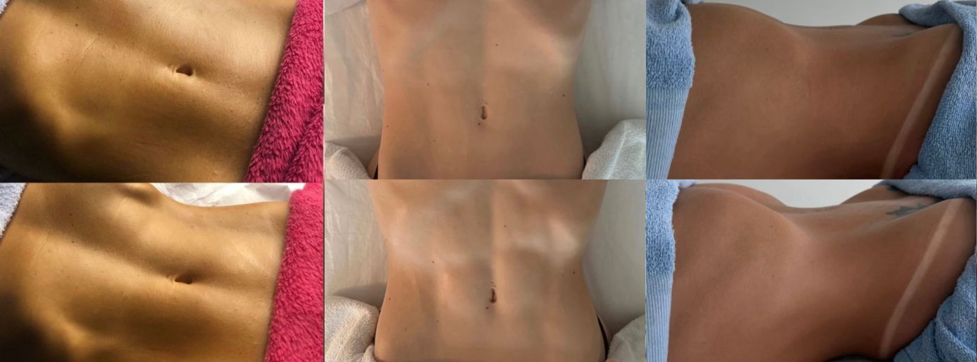 Para redução de medidas: 4 Sessões de DrenoRedux (Drenagem + Modeladora)