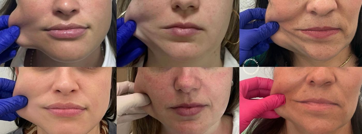 Pele mais firme e jovem! Aplicação de 1 seringa de Bioestimulador de Colágeno Rennova Diamond® para o rosto