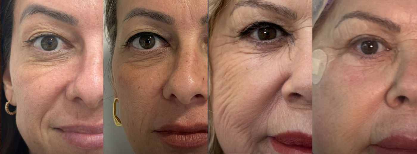 Aplicação de Bioestimulador de Colágeno Elleva®: mais Firmeza, Sustentação e Colágeno para Face!
