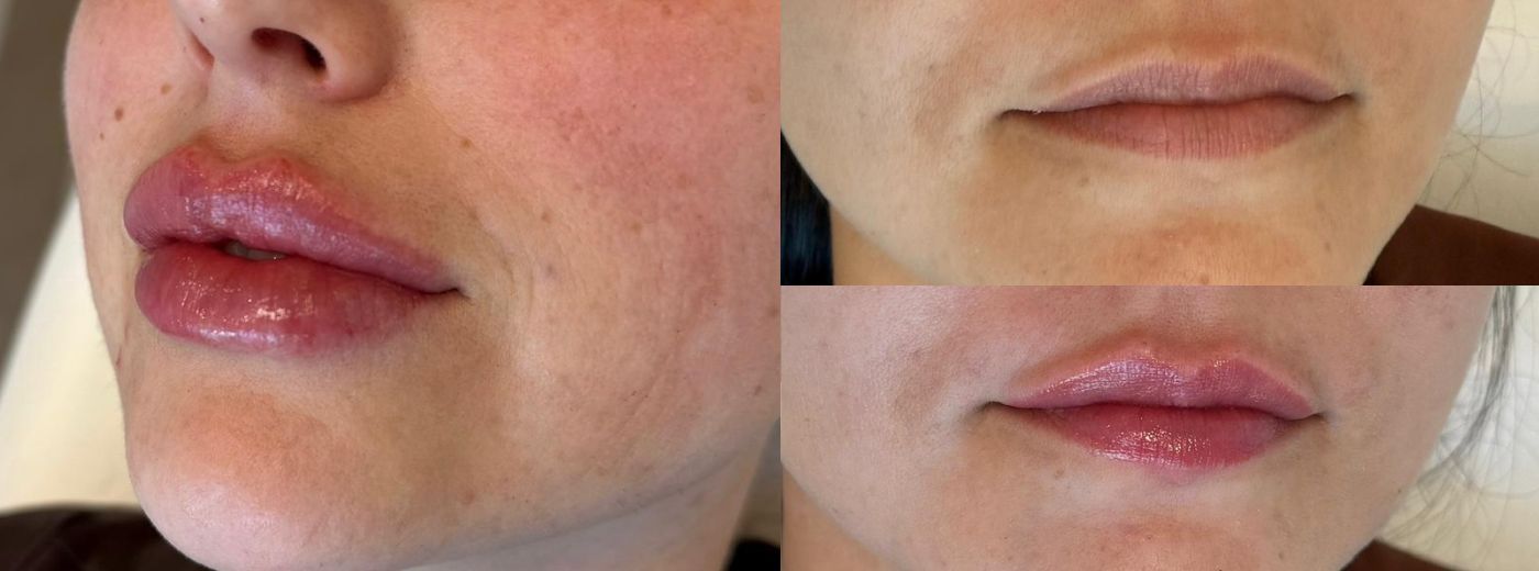 Preenchimento Labial com 1ml de Ácido Hialurônico Biogelis®
