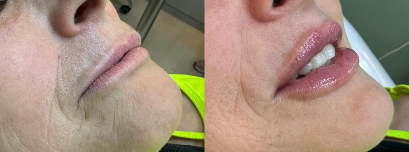 Lábios ultrabeijáveis: Preenchimento com 1ml de Ácido Hialurônico + GANHE Hydragloss!