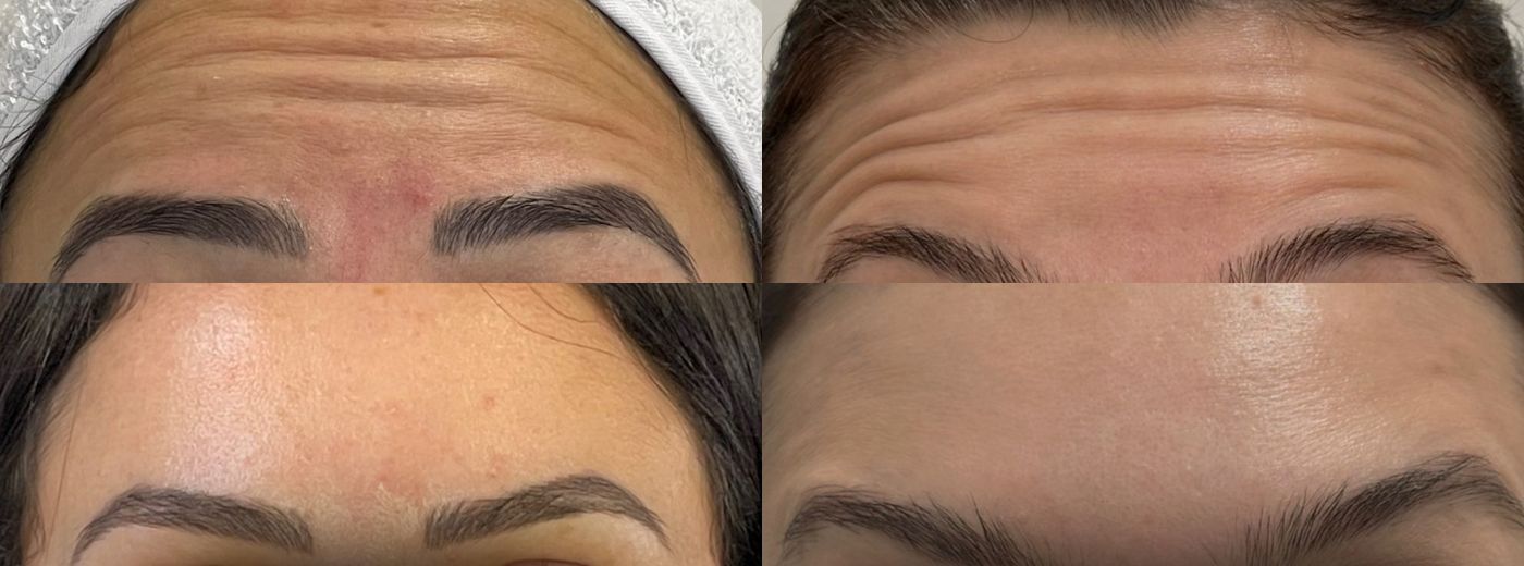 Botox Club! Pacote anual para 3 aplicações de Botox® Allergan Full Face + 3 sessões de Microagulhamento e Skinbooster