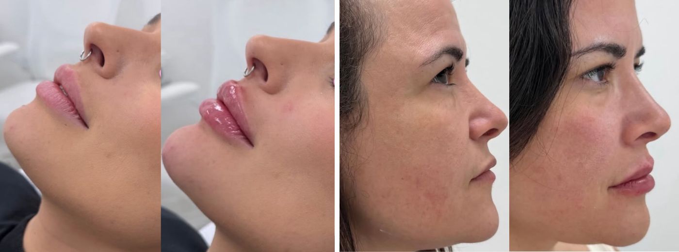 Perfiloplastia com 3ml de Ácido Hialurônico: Preenchimento de nariz e queixo para um perfil harmônico!