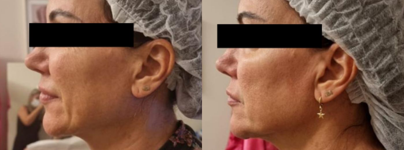 Ultrassom Microfocado Herus Hifu 4D para terço inferior (do nariz ao queixo) + olhos ou papada + GANHE Microagulhamento