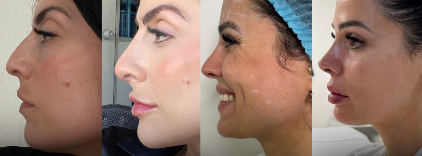 Perfiloplastia com 3ml de Ácido Hialurônico: Preenchimento de nariz e queixo para um perfil harmônico!