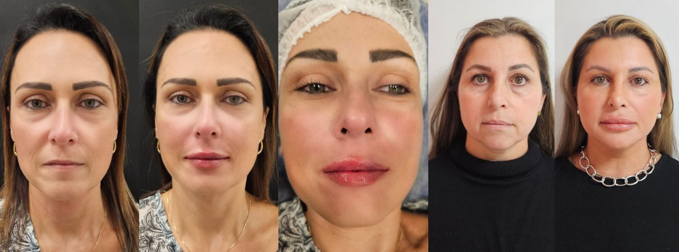 Full Face! Preenchimento com 4ml de Ácido Hialurônico