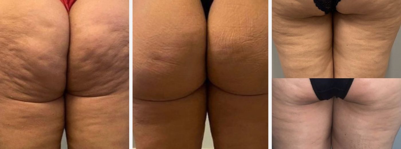 Tratamento de choque para celulite: Subcisão + Bioestimulador de Colágeno (Hidroxiapatita de Cálcio) + GANHE 2 sessões de Radiofrequência!