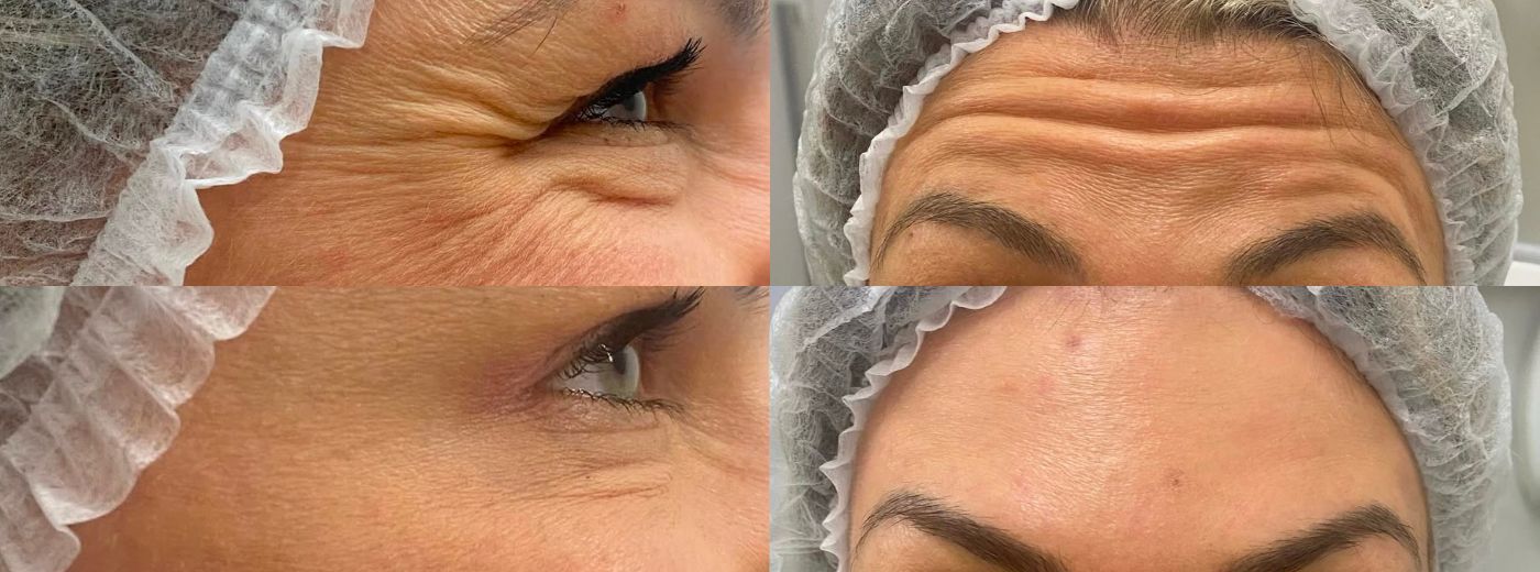 Toxina Botulínica para Testa + Olhos + Glabela - GANHE 4 Drenagens Renata França comprando em Agosto!