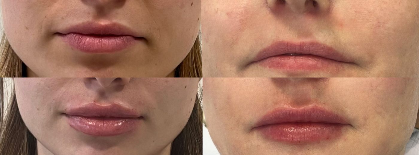 Preenchimento com 1ml de Ácido Hialurônico Rennova Lift® para Lábios, Olheiras ou Sulco Nasogeniano
