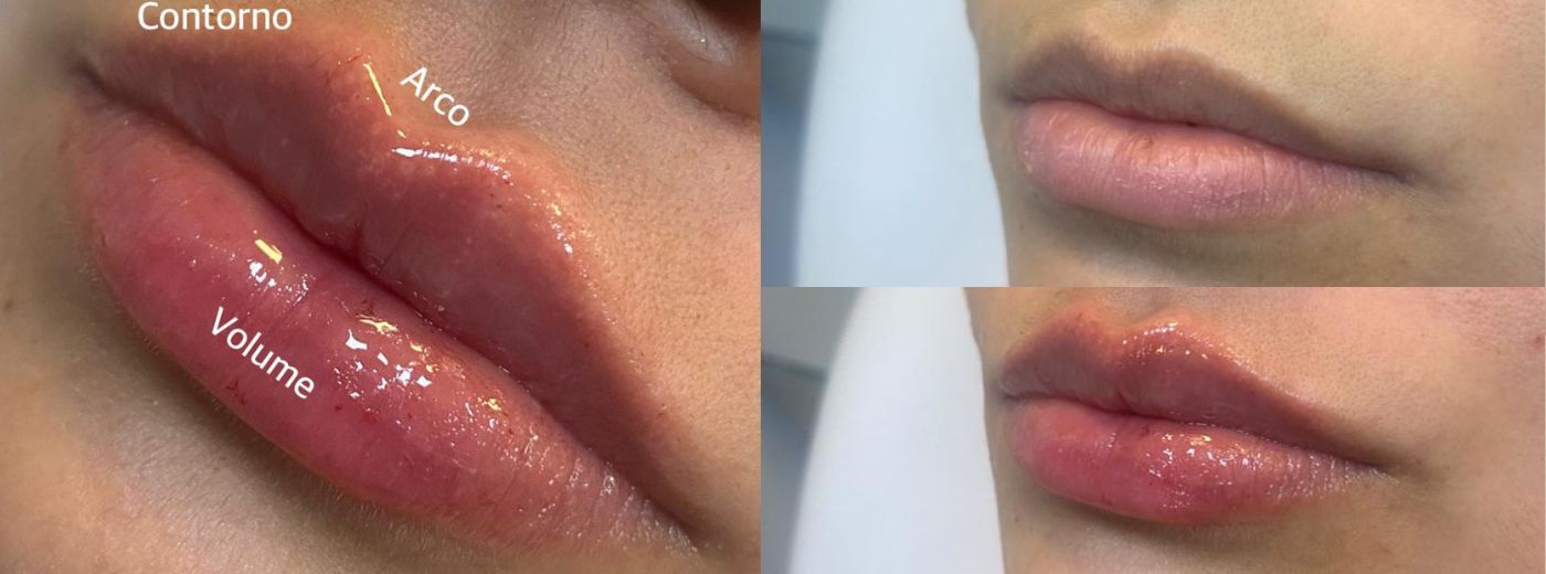 Lábios ultrabeijáveis: Preenchimento com 1ml de Ácido Hialurônico + 1 GANHE Hydragloss!