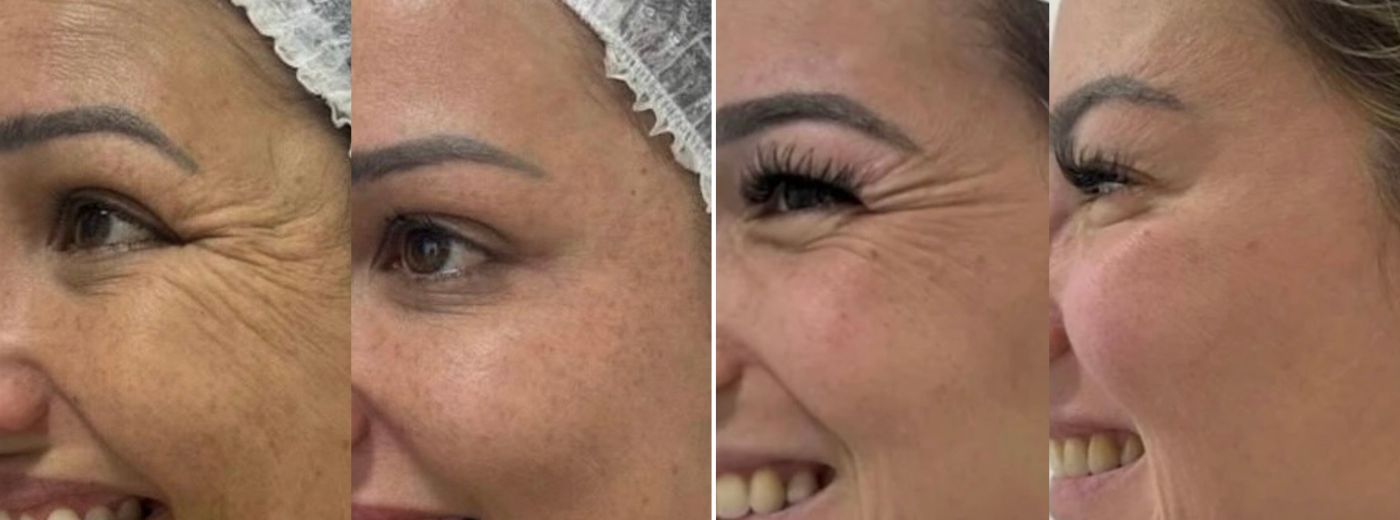Aplicação de Botox Allergan® ou Xeomin® para 3 Regiões + GANHE Peeling Químico ou Hidratação Facial!