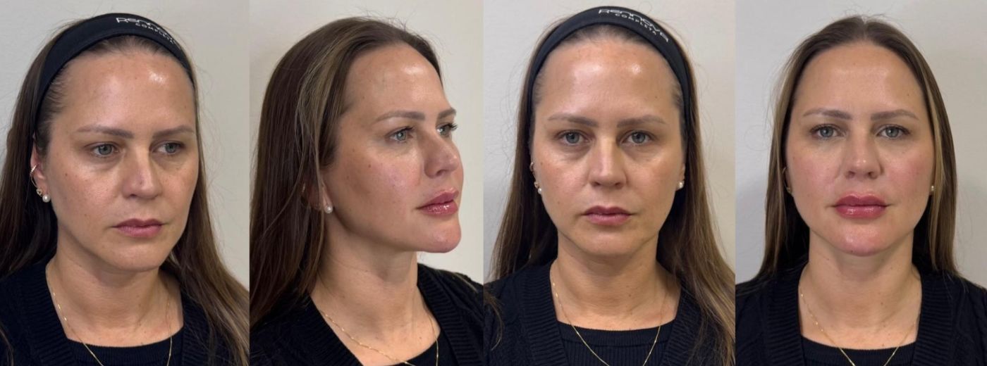 Full Face! Preenchimento com 4ml de Ácido Hialurônico para o rosto!
