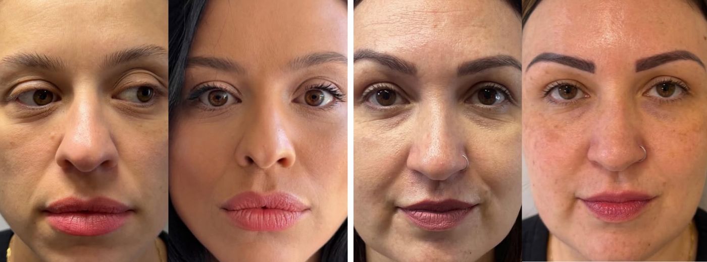 Aplicação de Bioestimulador de Colágeno Elleva®: mais Firmeza, Sustentação e Colágeno para Face!