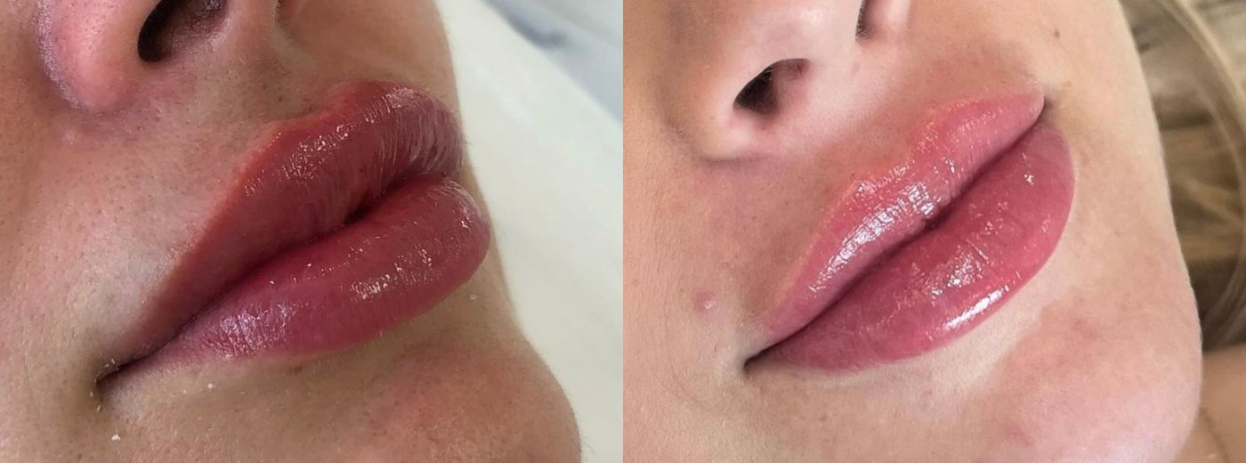 Preenchimento Labial com 1ml de Ácido Hialurônico - Por tempo LIMITADO!