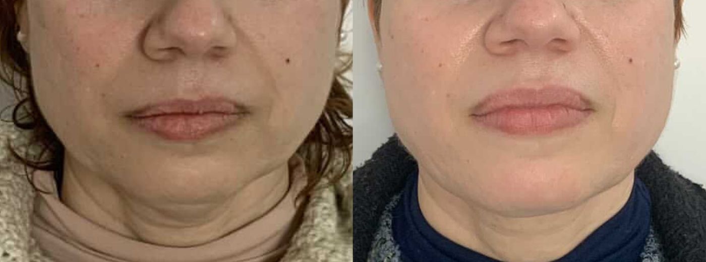 Aplicação de Ácido Deoxicólico para Redução de Papada + Mandíbula