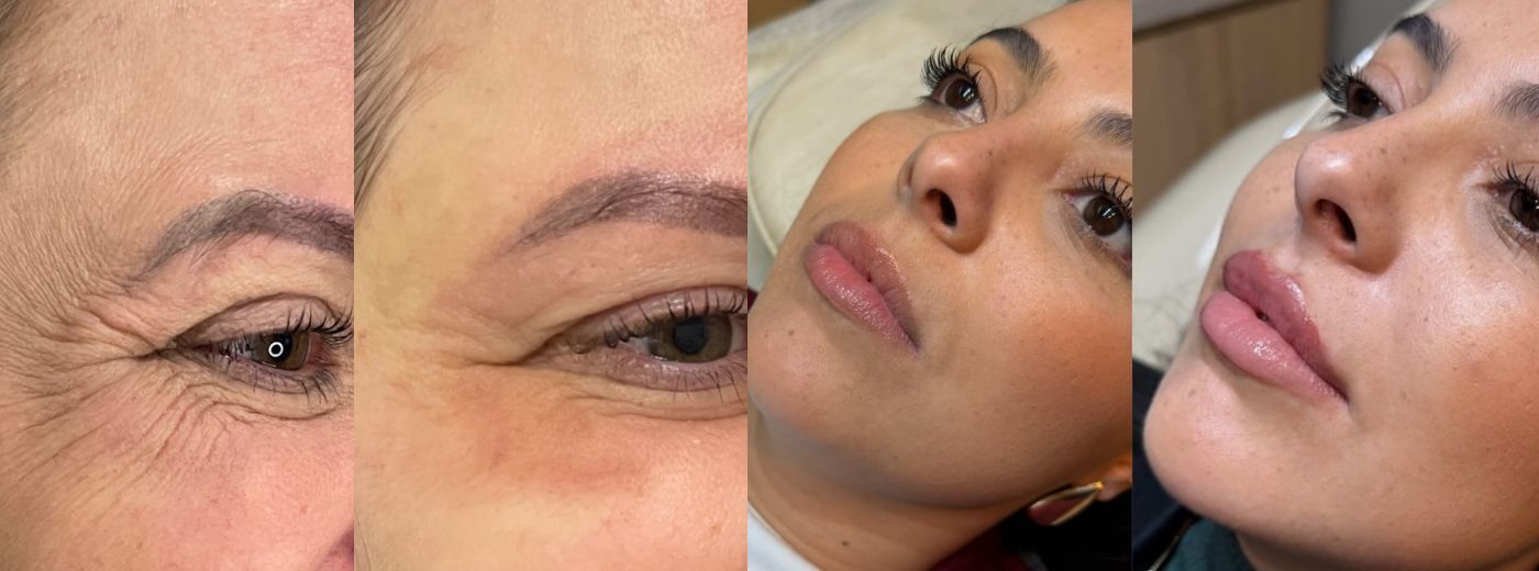 Toxina Botulínica Coreana Letybo® para 3 Regiões + Preenchimento com 1ml de Ácido Hialurônico