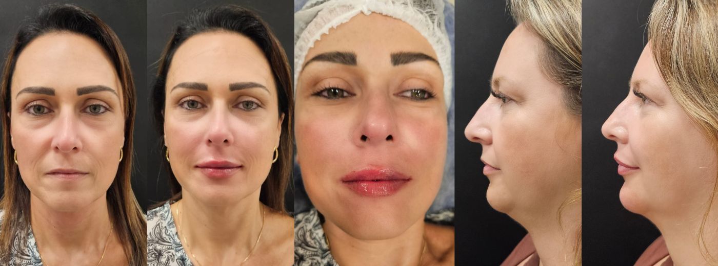 Full Face! Preenchimento com 4ml de Ácido Hialurônico