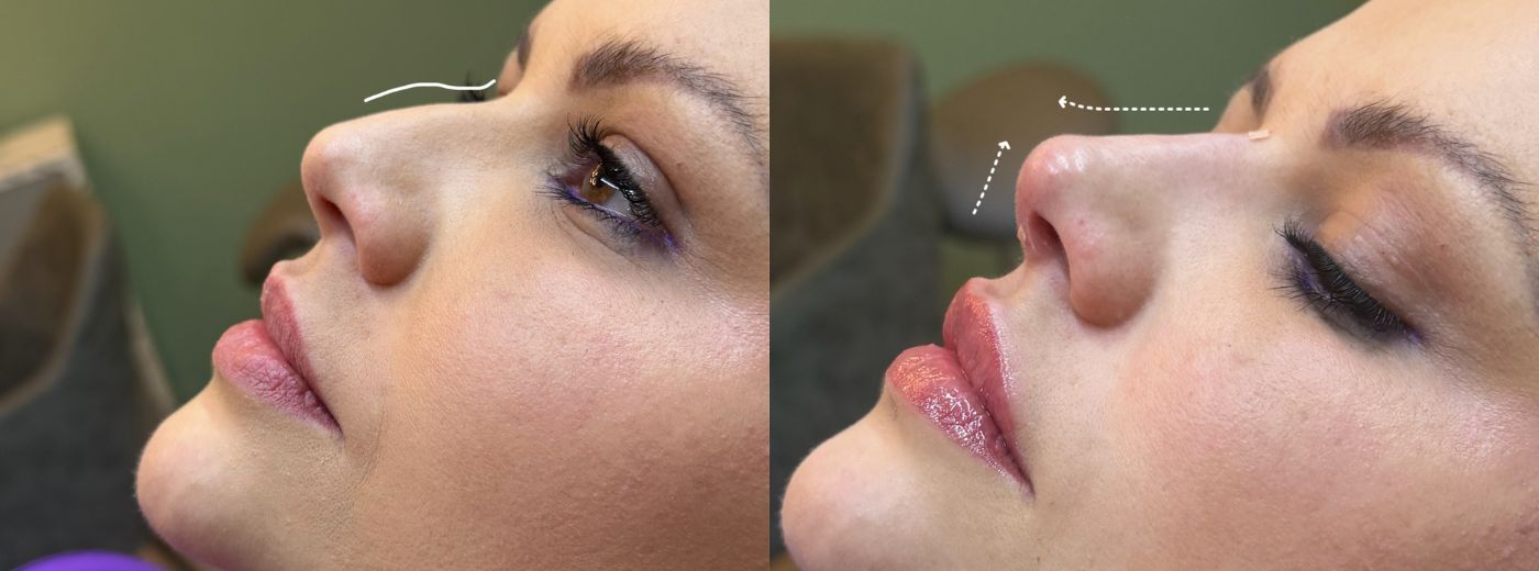 Rinomodelação: Preenchimento com 1ml de Ácido Hialurônico para afinar, empinar ou corrigir assimetrias do Nariz