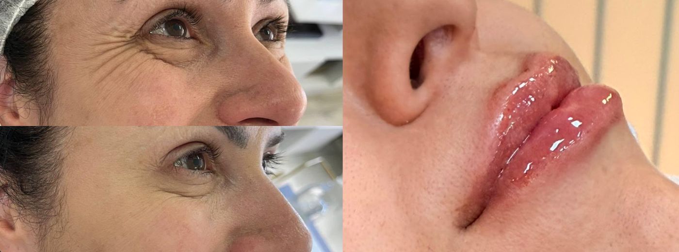 Toxina Botulínica para 3 Regiões + Preenchimento Labial com 1ml de Ácido Hialurônico