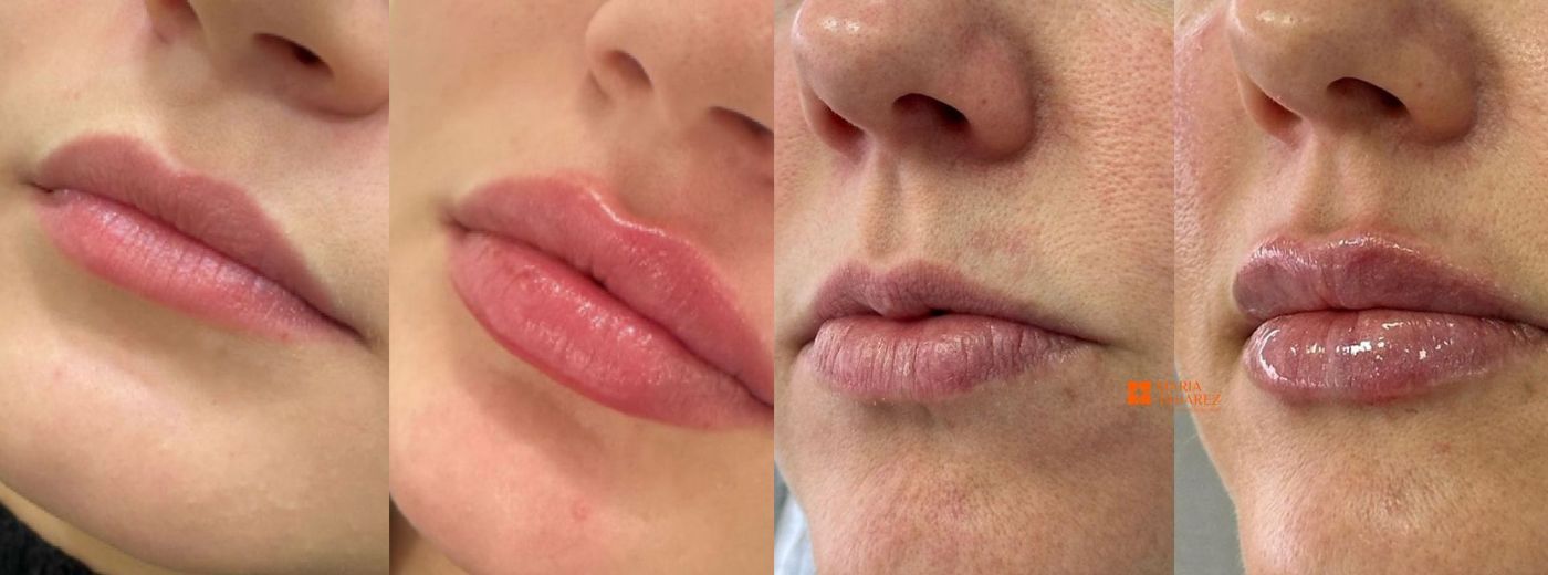 Preenchimento com 1ml de Ácido Hialurônico Rennova para Lábios, Olheiras, Queixo OU Sulco Nasogeniano- Mais Volume, com Naturalidade!