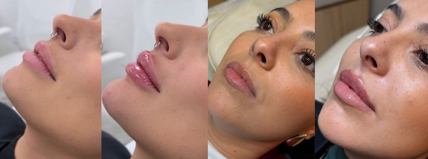 Perfiloplastia com 3ml de Ácido Hialurônico: Preenchimento de nariz e queixo para um perfil harmônico!