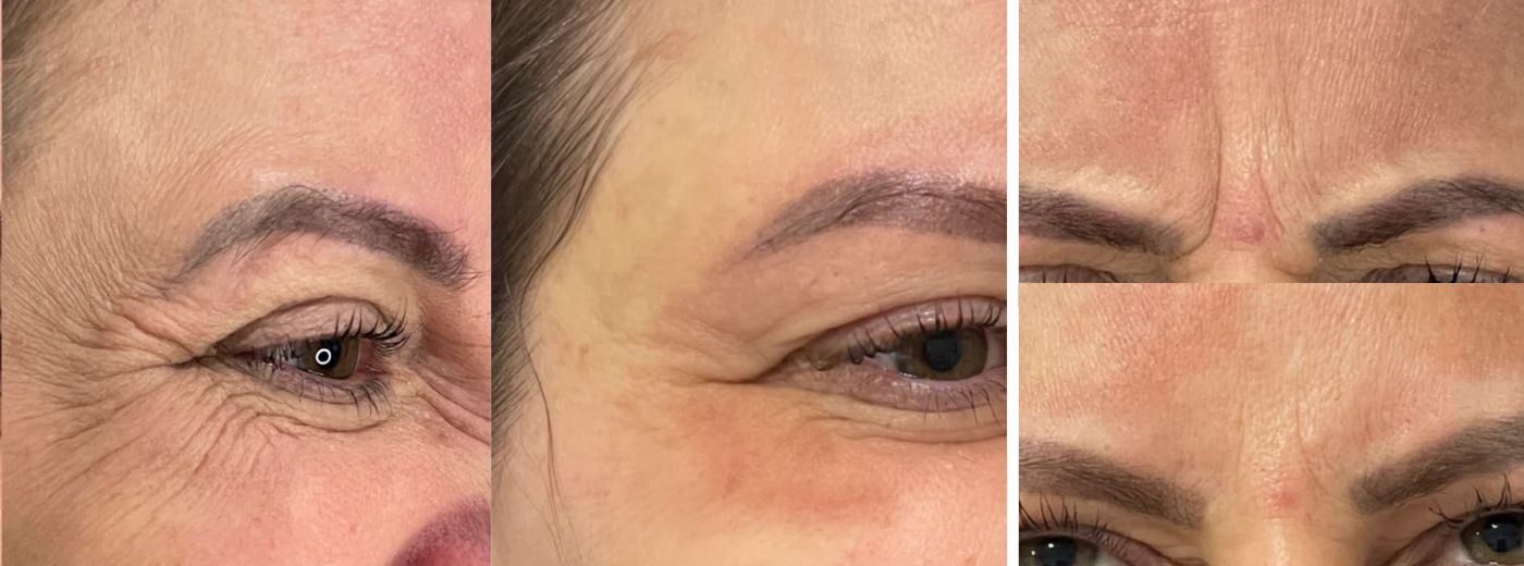 Toxina Botulínica Coreana Letybo® para Testa + Olhos + Glabela