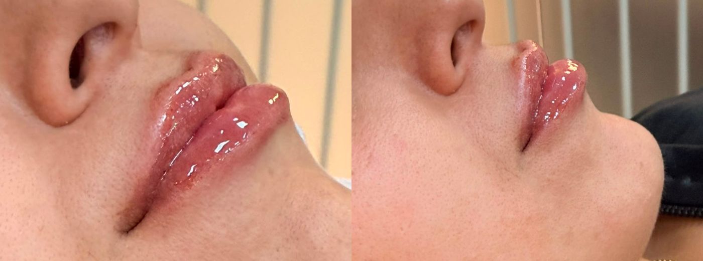 Preenchimento Labial com 1ml de Ácido Hialurônico Rennova® - Válido somente para as 10 primeiras compras!